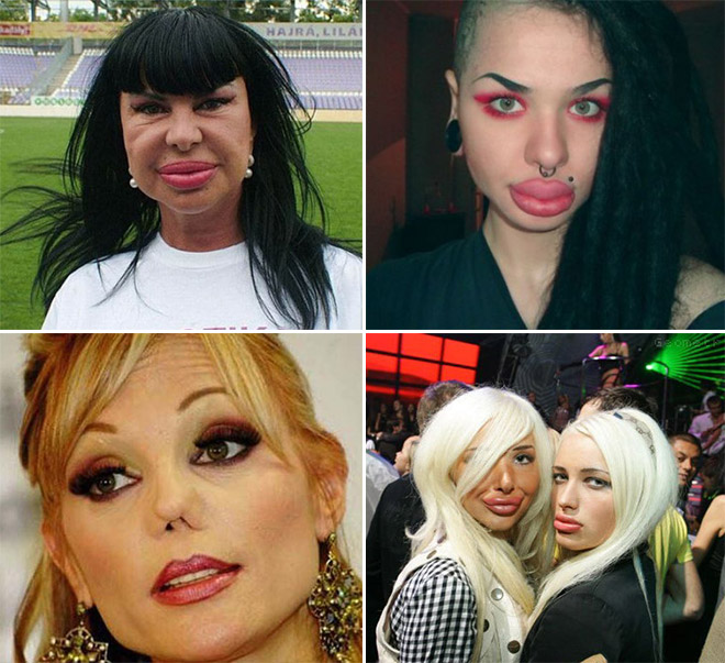 Plastic Surgery Gone Wrong.